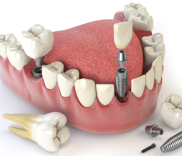 hampaiden puhdistus Turku, hammaskiven poisto, posliinipaikka hampaiden puhdistus Turku, valkaisu Turku, hammaskiven poisto Turku